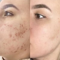 بانوكسيل - غسول رغوي لحب الشباب بنزويل بيروكسيد 4%