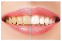 مصحح لون الاسنان