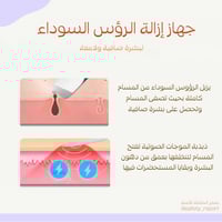 جهاز إزالة الرؤوس السوداء