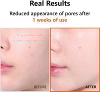 سيروم هايبر نياسيناميد من ازنتري