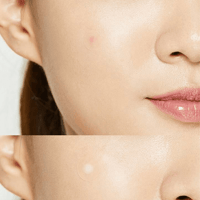 كوسركس لصقات السيطرة على حب الشباب 24 لزقة