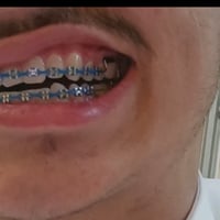 تقويم فكين بدون غرا متصل