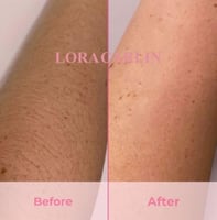 جهاز لورا لإزالة شعر الجسم كامل