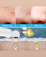 جهاز الهايدرافيشل المنزلي