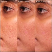 كودالي فينو بيور محلول ساليسيليك لعلاج البقع 15 مل...