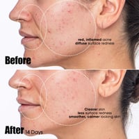 صنداي رايلي سيروم علاج حب الشباب 8 مل ميني