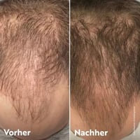 اهوهو مجموعة العناية تكثيف ومنع تساقط الشعر 3 قطع