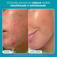 مقشر باولا تشويس محلول مقشر للبشره 2% - 118مل