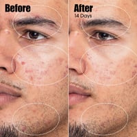 صنداي رايلي سيروم علاج حب الشباب 8 مل ميني