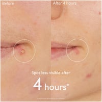 كودالي فينو بيور محلول ساليسيليك لعلاج البقع 15 مل...