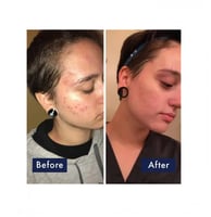 غسول رغوي لحب الشباب بنزويل بيروكسيد 10٪ من بانوكس...