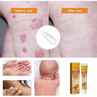 كريم سم النحل للصدفية