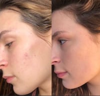 مسحات حب الشباب المعجزة القطنية لإزالة حب الشباب م...