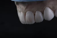 118 بكيج وجوه خزفية من الإيماكس 118 E.max veneers