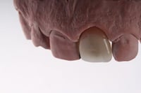 117 تاج خزف كامل طبقات من الإيماكس 117 E. max laye...