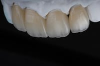 117 تاج خزف كامل طبقات من الإيماكس 117 E. max laye...