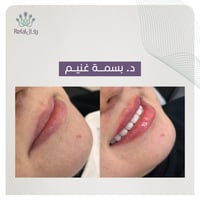 حقن الفيلر 1 مل