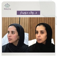 حقن الفيلر 1 مل