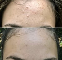 مسحات قطنية لعلاج حب الشباب من ستريدكس - 55 قطعة