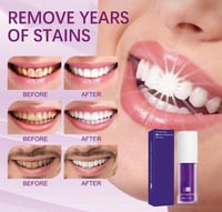 تبيض الأسنان