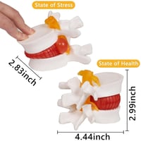 مجسم أمراض الانزلاق الغضروفي الديسك