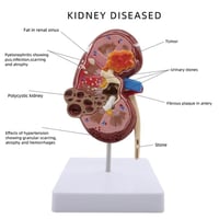 مجسم الكلية الطبيعي وأمراض الكلى