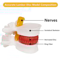 مجسم أمراض الانزلاق الغضروفي الديسك