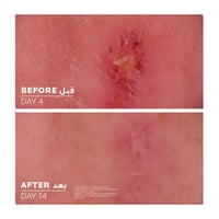 لاروش بوزيه سيكابلاست بوم بي 5+ كريم ملطف ومعالج 4...