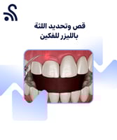 قص اللثة وتحديد اللثة بالليزر للفكين