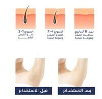 جهاز إزالة الشعر IPL المنزلي