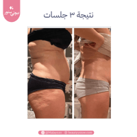 مساج الاخشاب