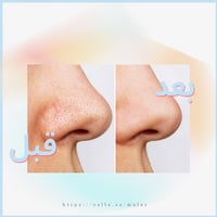 جهاز شفط الرؤوس السوداء بالكاميرا