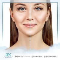 ميزو تفتيح ونضارة (ترانكساميك اسيد ) د.سعد الصقير