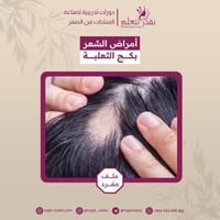 دورة علاج ثعلبة الشعر