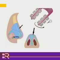 مقوم انف وردي
