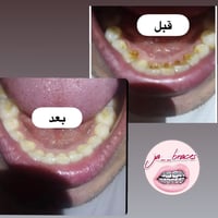 جهاز الترا لتنظيف الاسنان