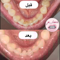 جهاز الترا لتنظيف الاسنان