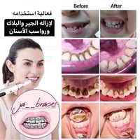 جهاز الترا لتنظيف الاسنان