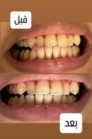 معجون كارتز لتبيض وتلميع الأسنان " كورس خمسه حبات...