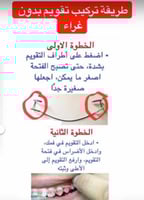 تقويم اسنان زينة (بكج) فك بدون غرا متصل " شامل الش...