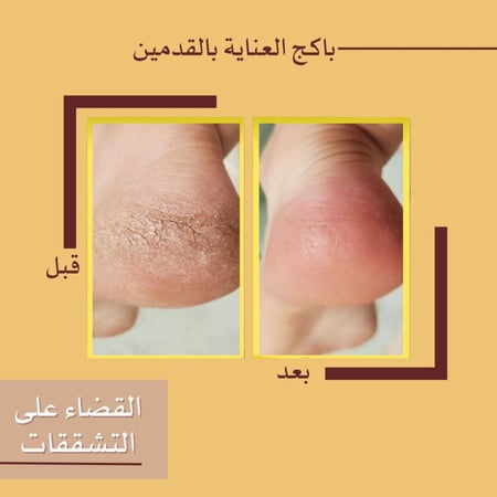 عرض كريم معالج تشققات القدمين 3عبوات