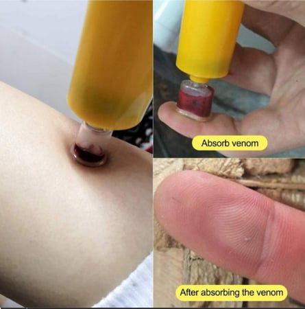 مجموعة ازالة سم الأفاعي والعقارب ولدغات الحشرات (حاصل على شهادة الاعتماد CE) شحن مجاني