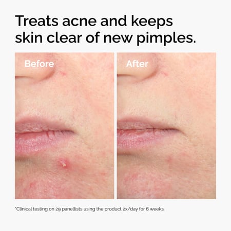 ذا أورديناري سيروم حمض الساليسيليك 2% للبشرة المعرضة لحب الشباب – 30 مل