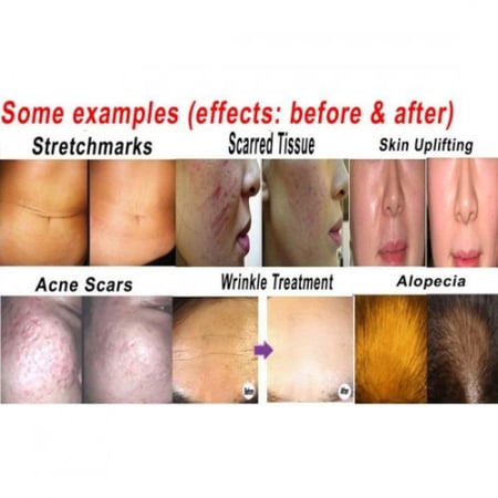 ديرما رولر 0.75 ملي عجلة عريضة 540 أبر تيتانيوم