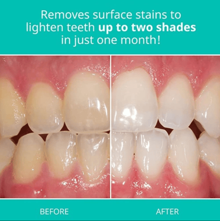 معجون أسنان أوباليسنس لتبييض فعّال وحماية اللثة – 75 جم 100 مل