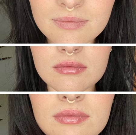 قلوس تكبير الشفايف