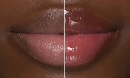 قلوس تكبير الشفايف