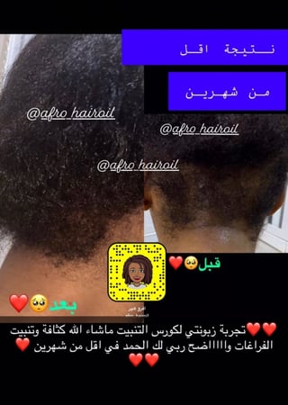 كورس- التنبيت -الشعر-العلاجى- شهر