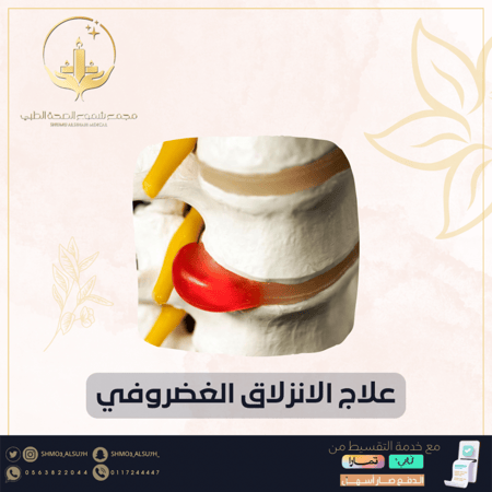 علاج الانزلاق الغضروفي