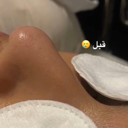 جهاز تنظيف البشرة